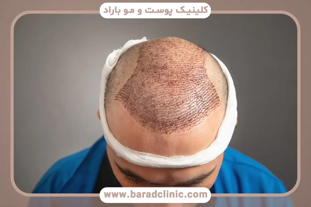 شرایط جسمی از مهمترین شرایط کاشت مو