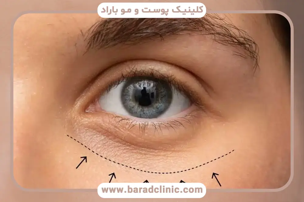 عوارض جراحی بلفاروپلاستی تحتانی