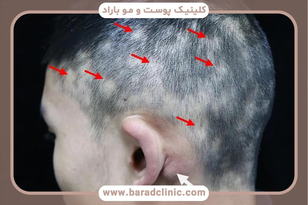 اختلال جریان لنفاوی پوست سر