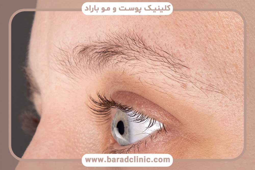 کاشت ابرو در بیماران مبتلا به آلوپسی