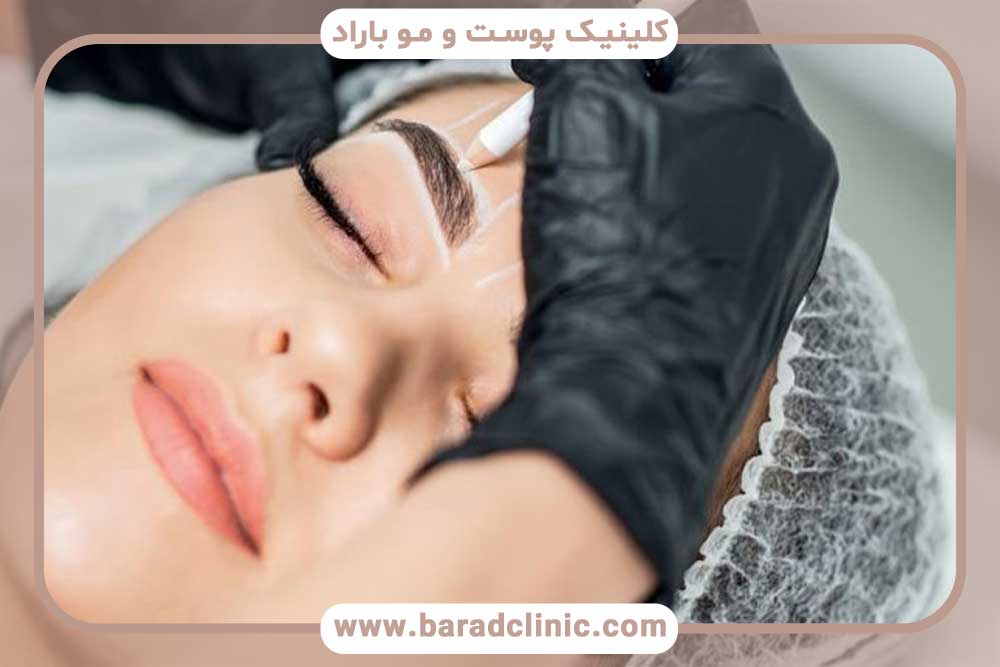 کاشت ابرو پهن