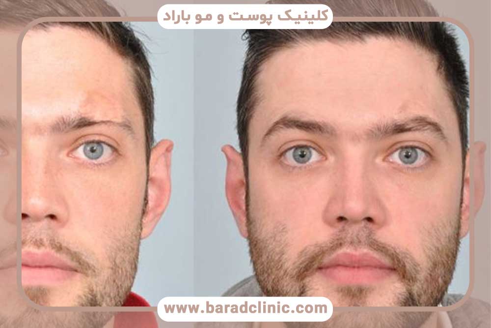 کاشت ابرو طبیعی مردانه تهران