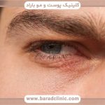 کاشت ابرو مردانه قسطی تهران