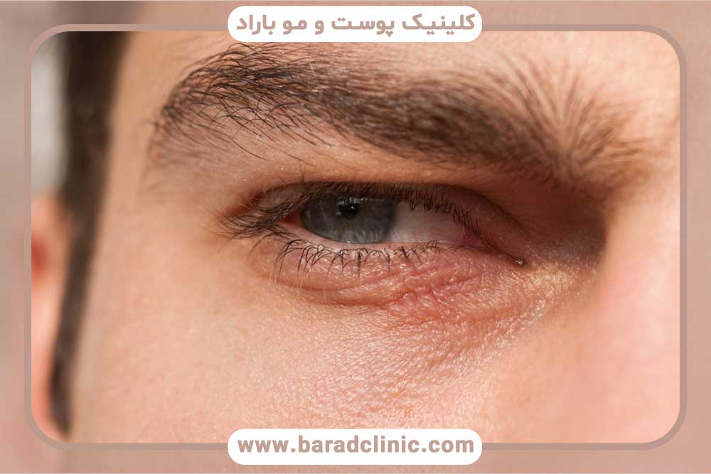 کاشت ابرو مردانه قسطی تهران