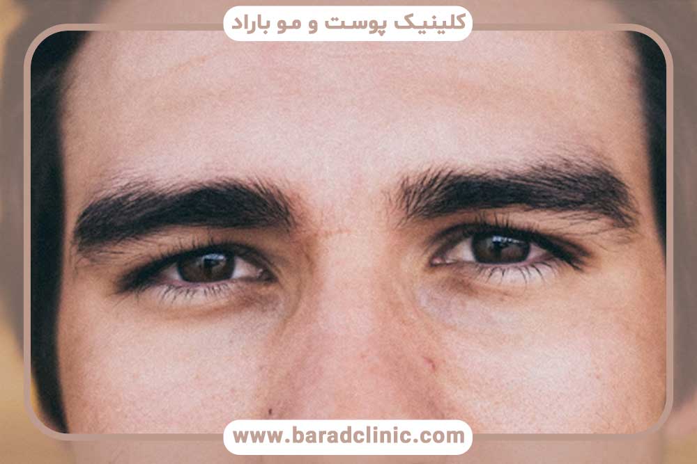 قیمت کاشت ابرو طبیعی مردانه تهران