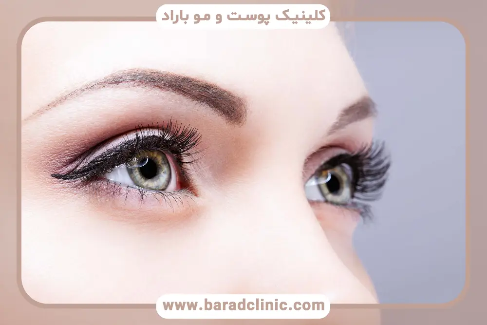 بلفاروپلاستی بدون جراحی تهران