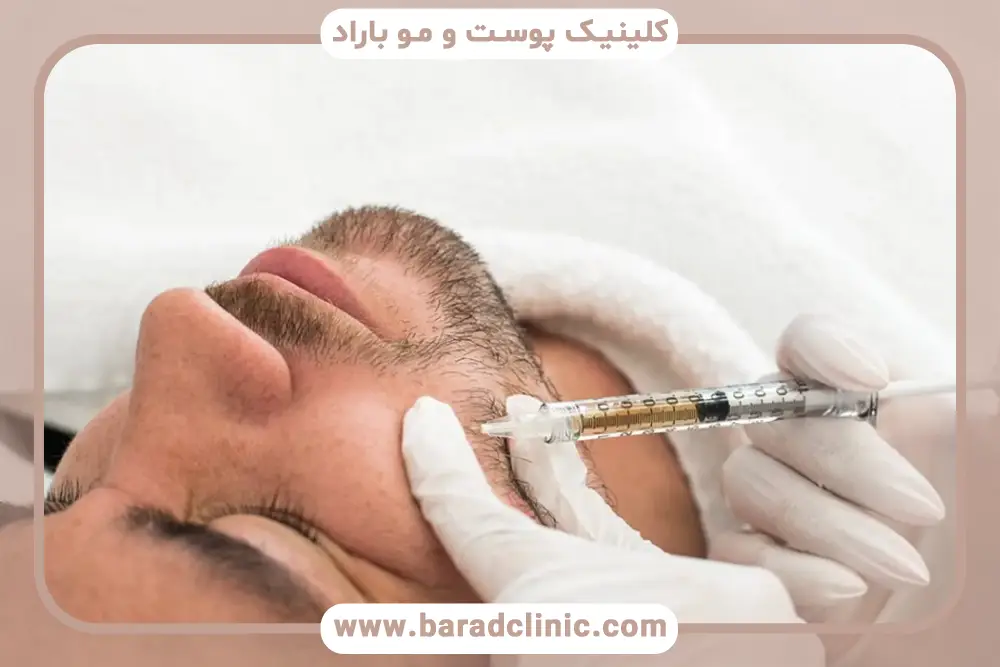 مزوتراپی ریش بعد از کاشت ریش