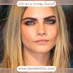 کاشت ابرو دخترانه برای صورت کشیده قسطی