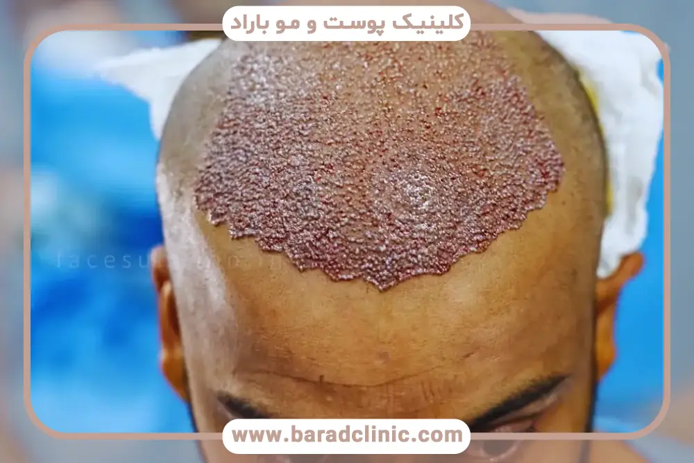 ریزش مو بعد از کاشت مو