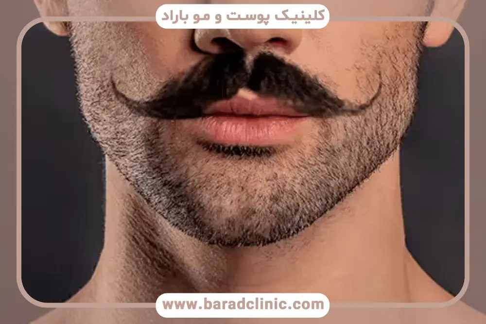 دوره نقاهت کاشت سبیل