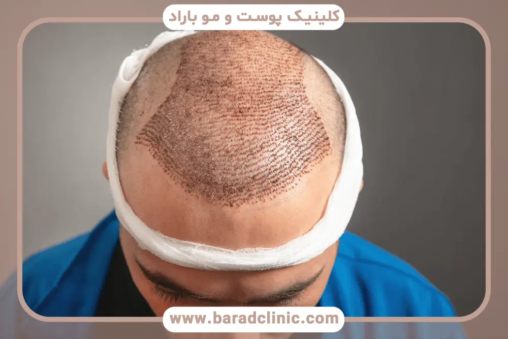 نمونه کاشت مو