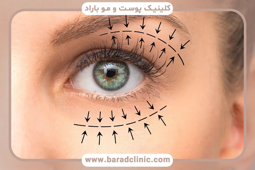 هزینه جراحی بلفاروپلاستی فوقانی