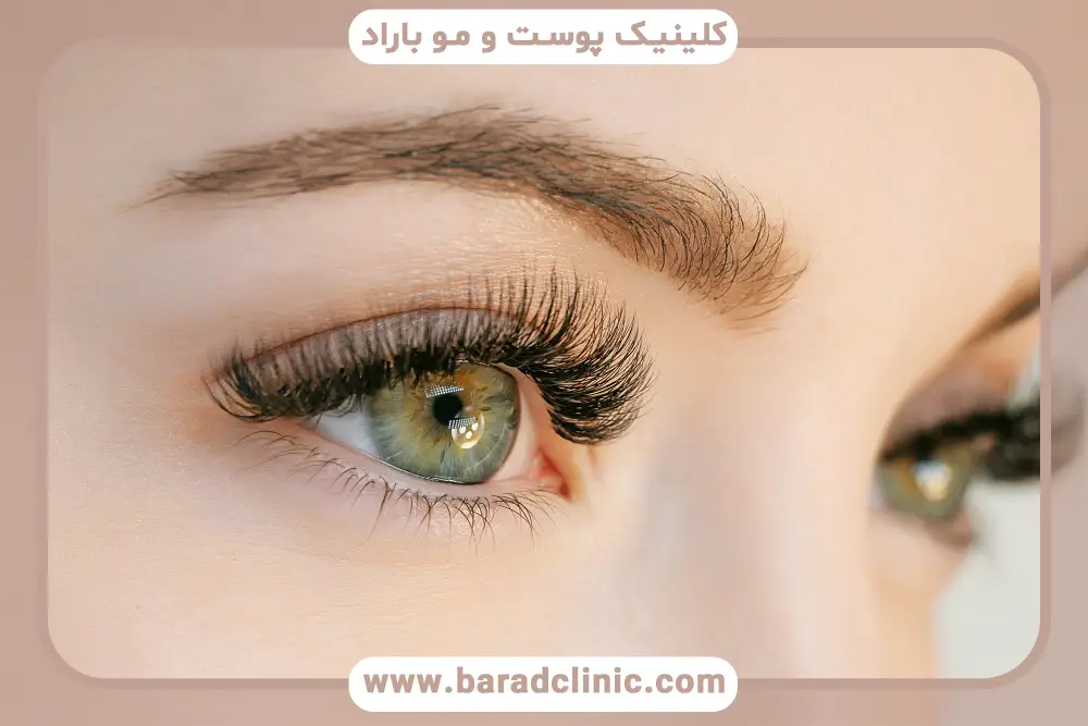 بلفاروپلاستی بدون جراحی غرب تهران
