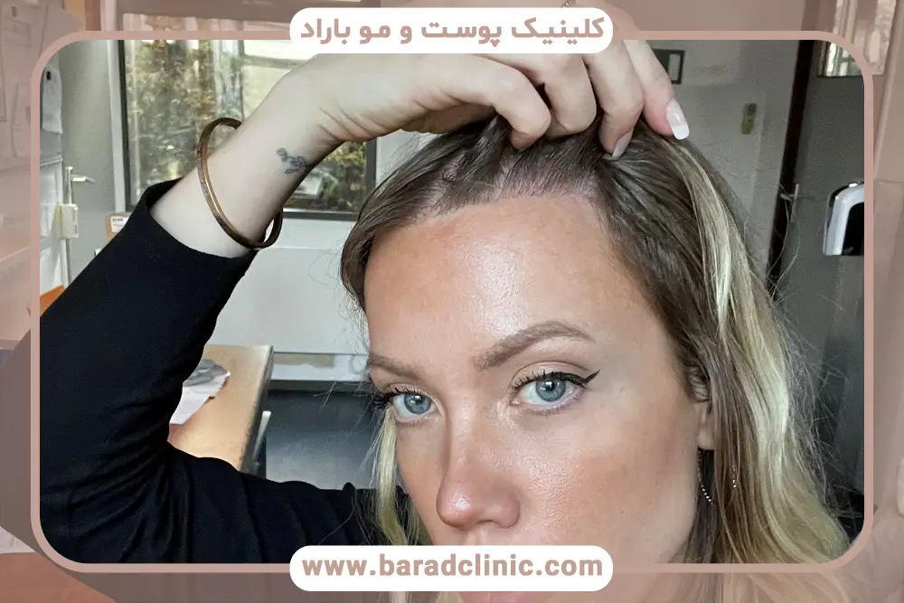 کاشت مو پیشانی زنان