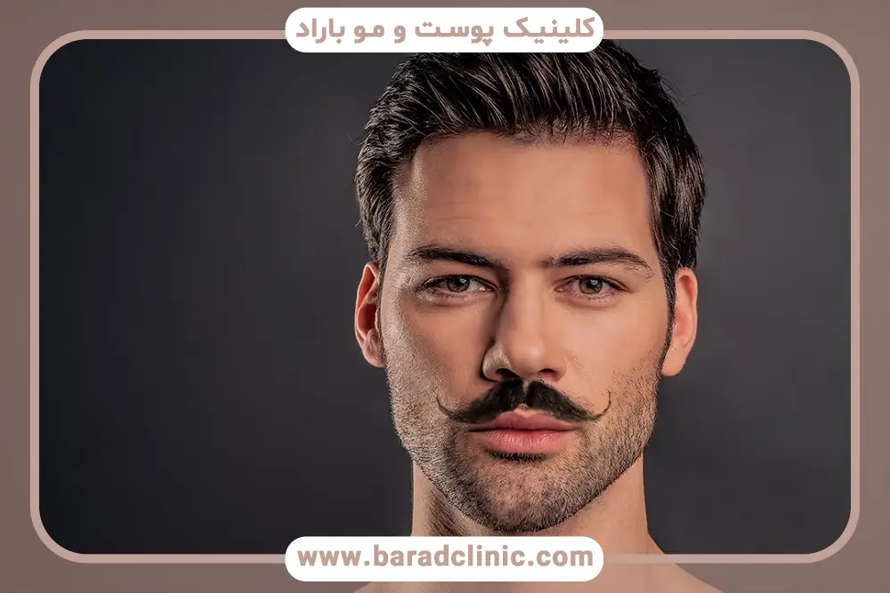 ماندگاری کاشت سبیل