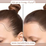 کاشت مو کم پشت