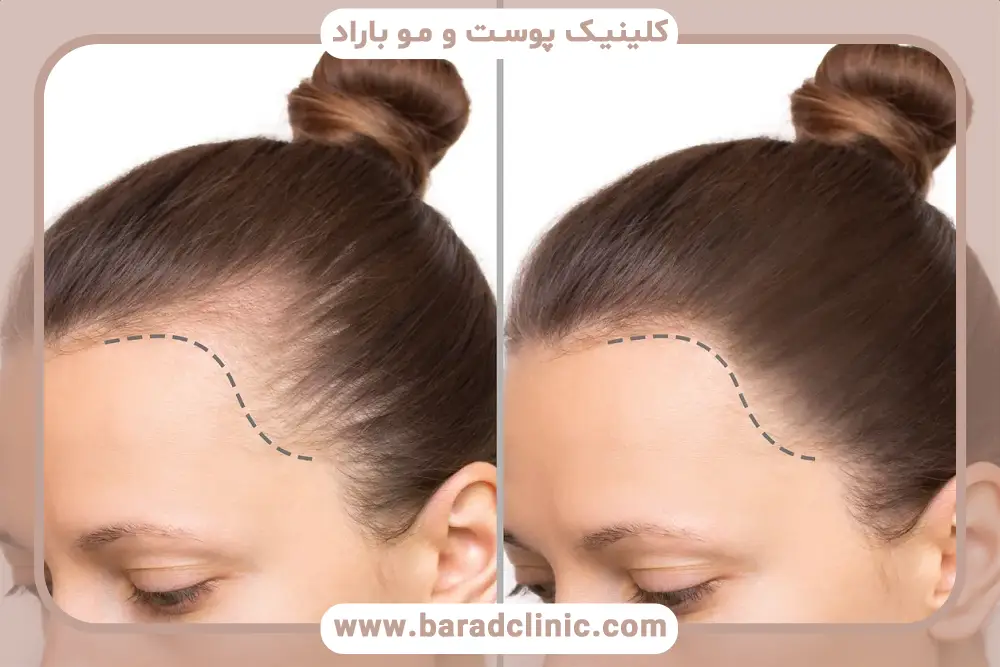 کاشت مو کم پشت