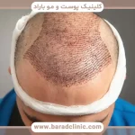 عدم مصرف فیناستراید بعد کاشت مو