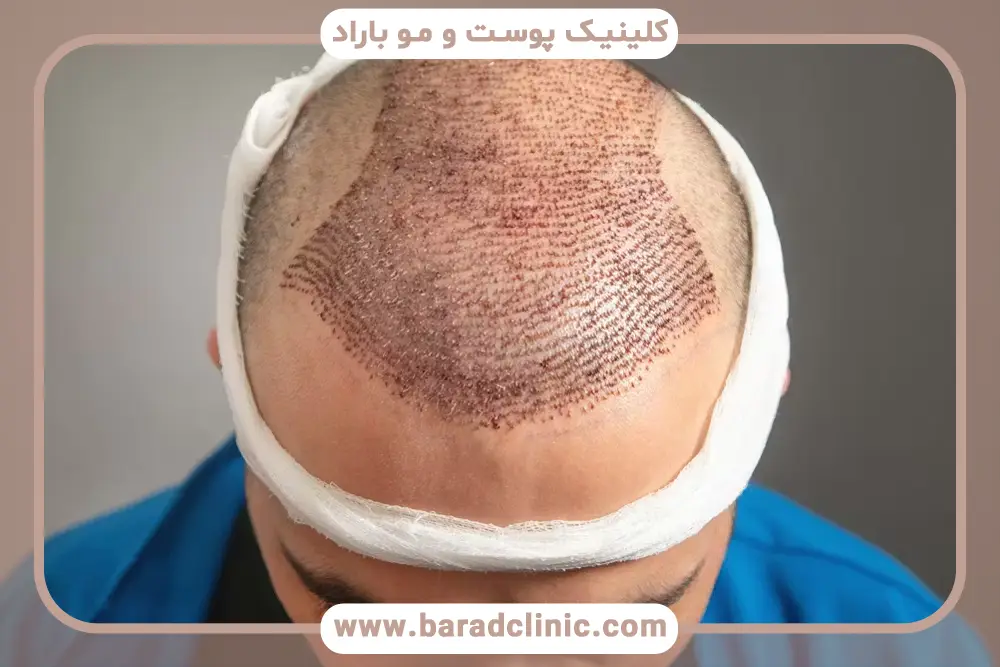 عدم مصرف فیناستراید بعد کاشت مو