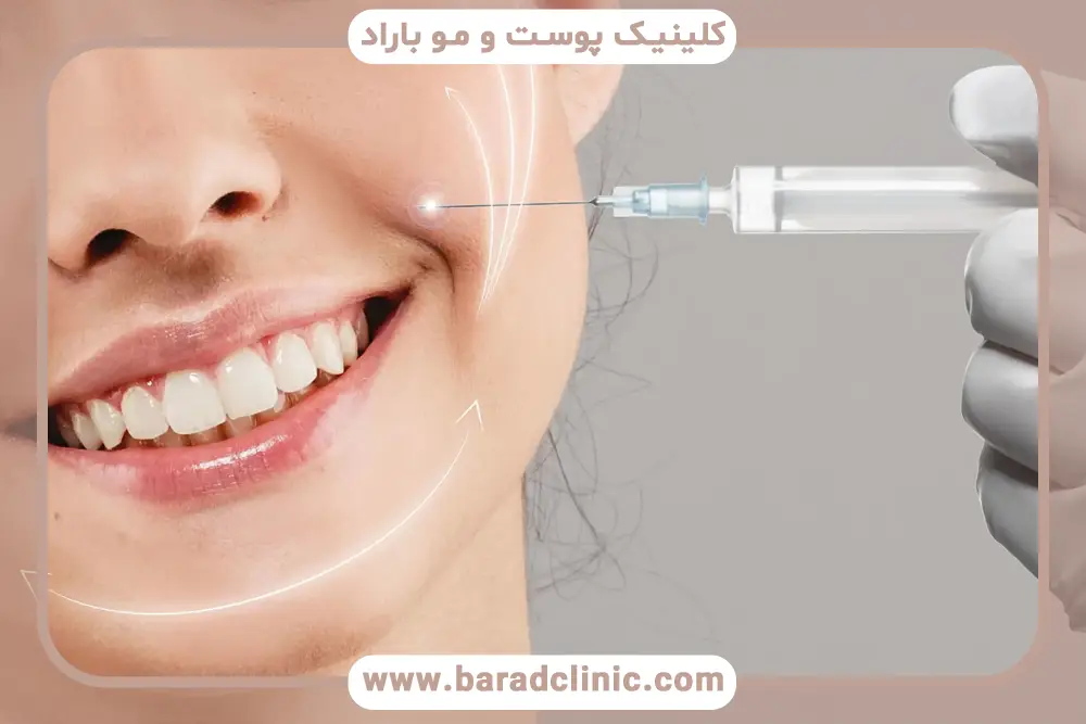 بوتاکس خط خنده