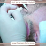 تعداد گرافت مو برای کاشت ریش