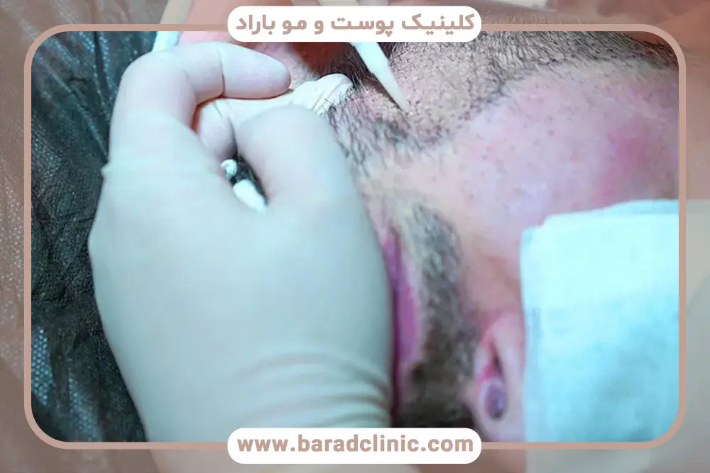 تعداد گرافت مو برای کاشت ریش