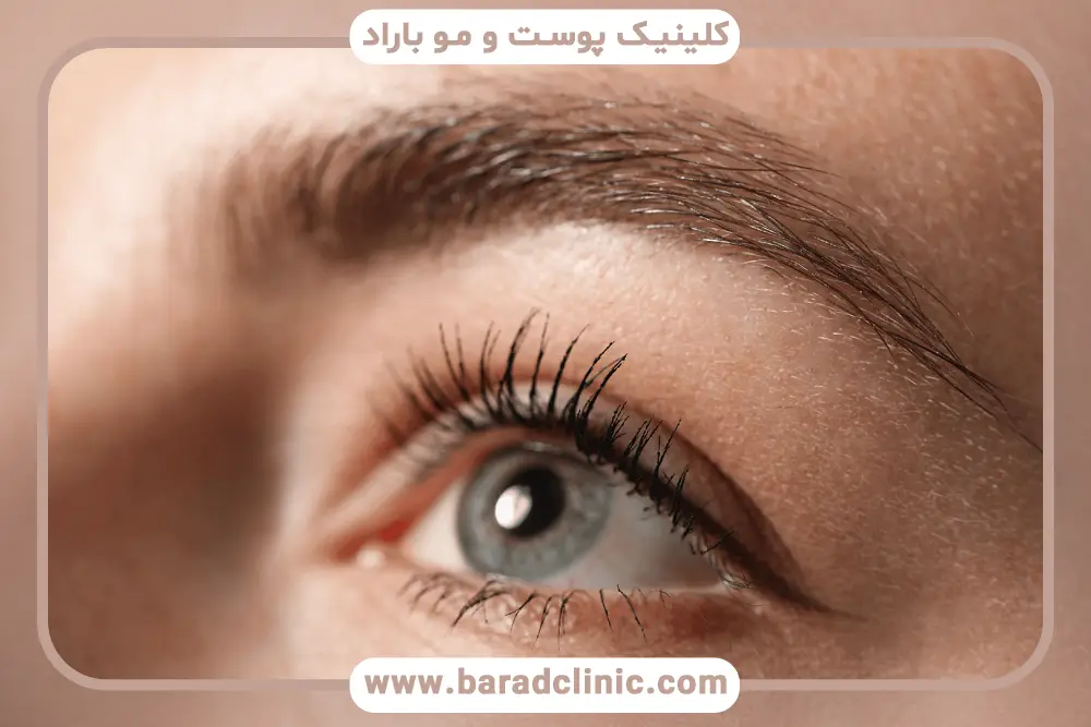 هزینه جراحی بلفاروپلاستی فوقانی غرب تهران