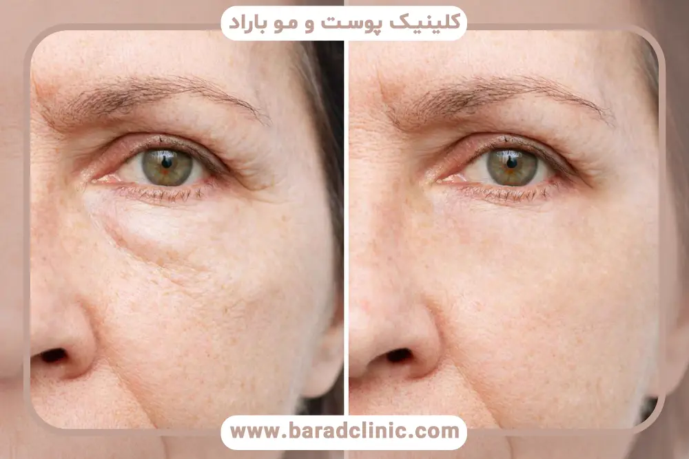 بوتاکس زیر چشم