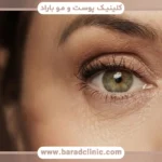 هزینه عمل بلفاروپلاستی غرب تهران