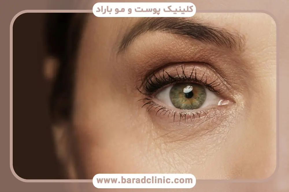 هزینه عمل بلفاروپلاستی غرب تهران