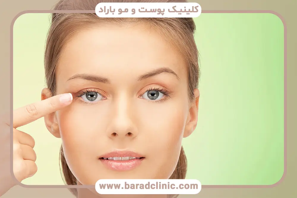 بلفاروپلاستی با لیزر تهران