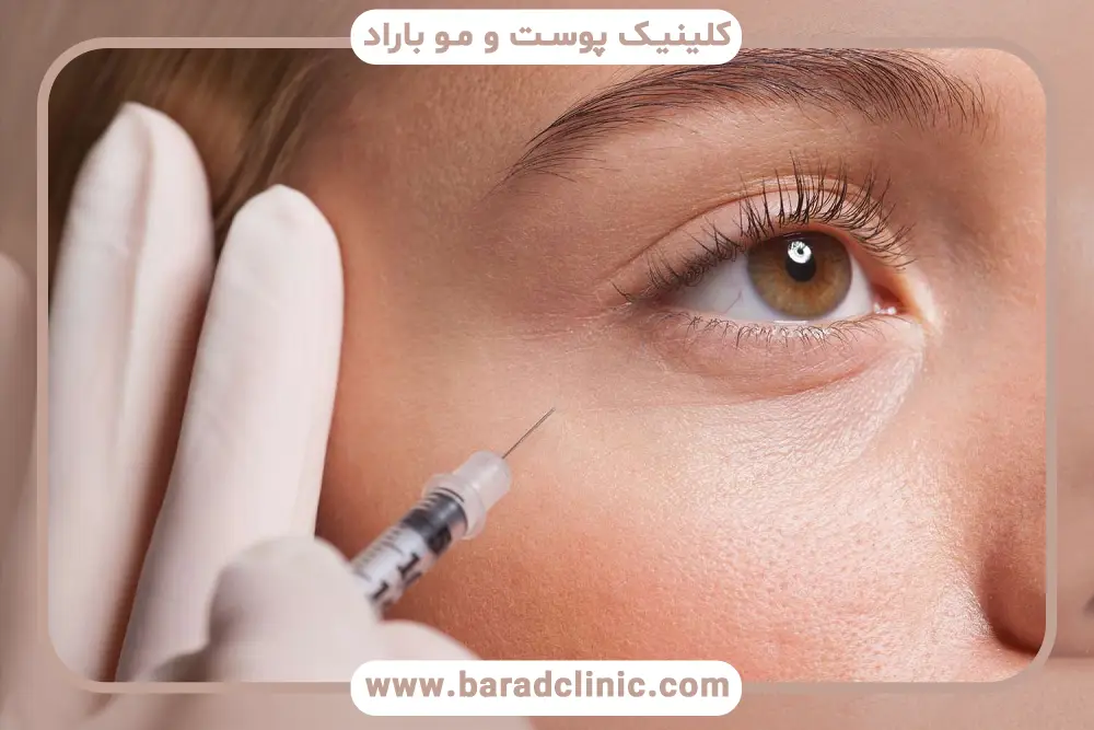 بوتاکس چشم