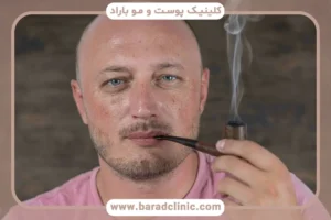 سیگار و مشروب بعد از کاشت مو