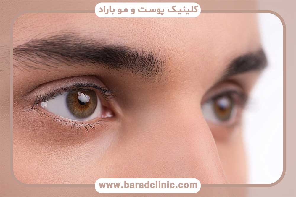 کاشت ابرو مردانه تهران