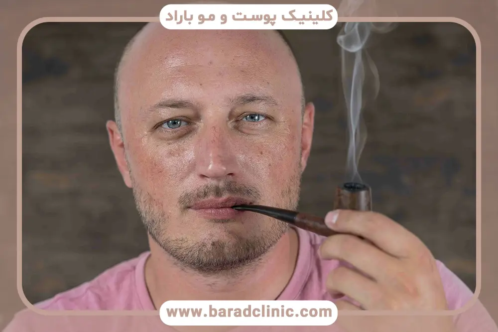 سیگار و مشروب بعد از کاشت مو