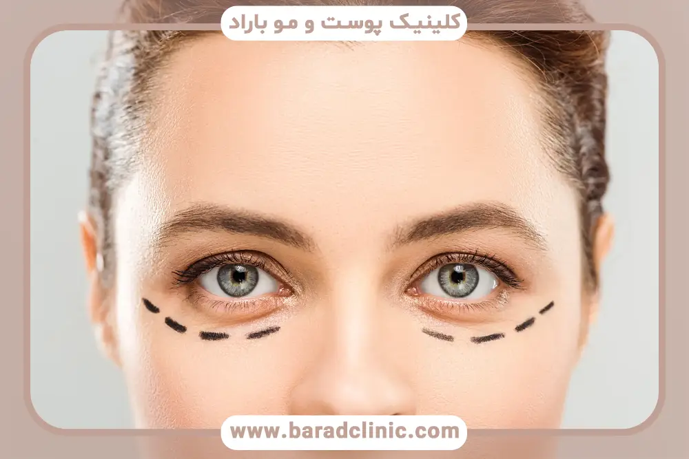 هزینه عمل بلفاروپلاستی تهران