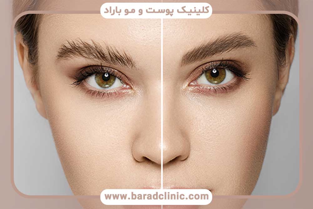 کاشت ابرو دخترانه با موی بلند