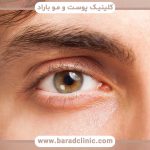 کاشت ابرو طبیعی مردانه