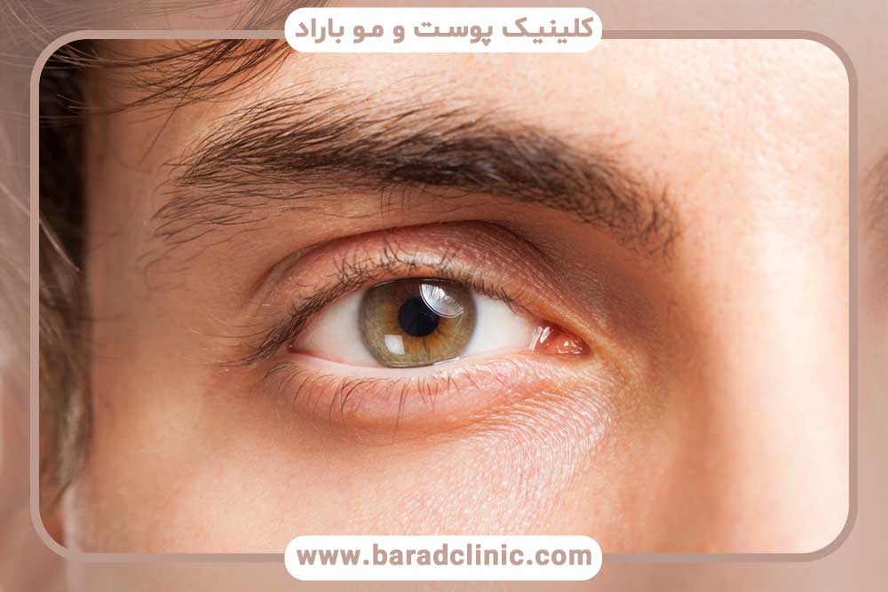 کاشت ابرو طبیعی مردانه