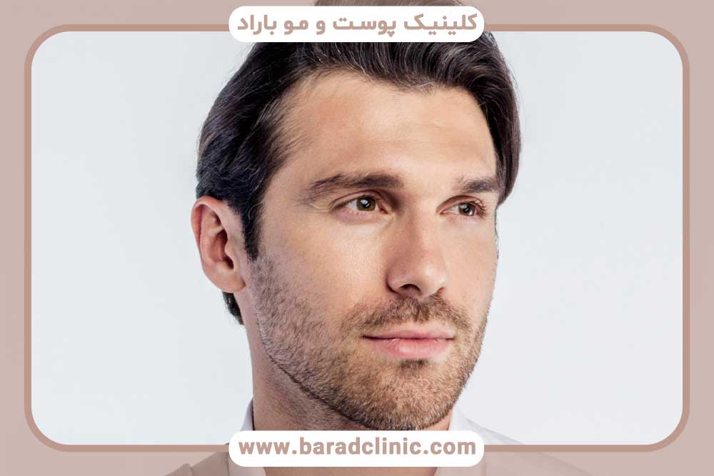 کاشت ابرو طبیعی مردانه تهران