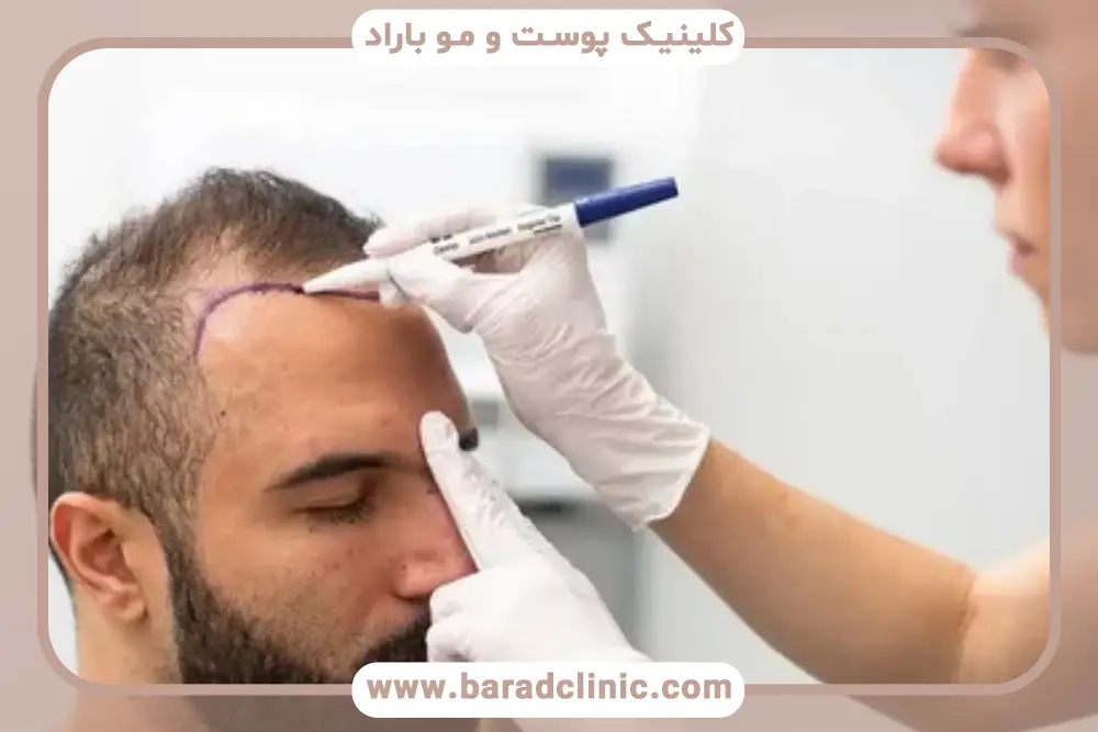 کاشت مو جلو پیشانی چیست؟