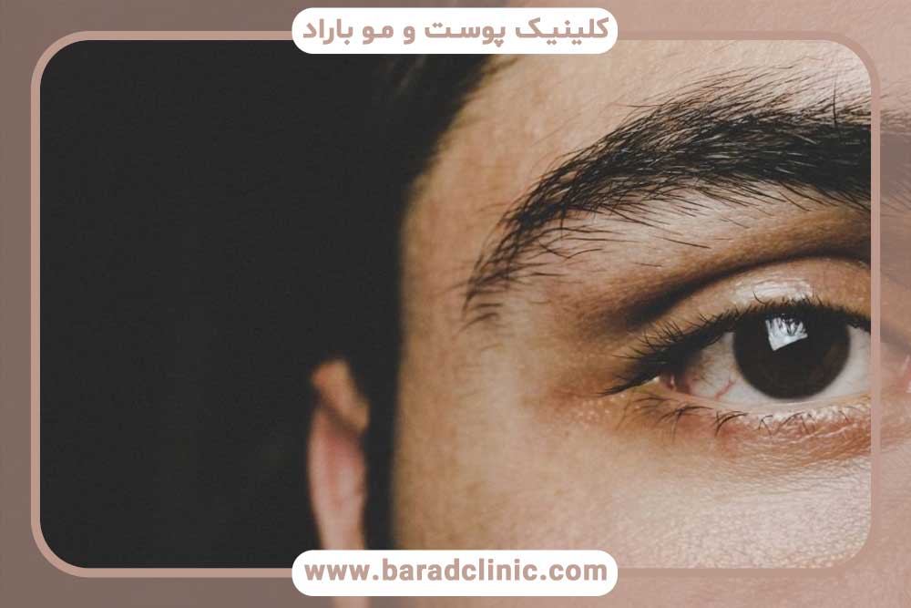 قیمت کاشت ابرو مردانه