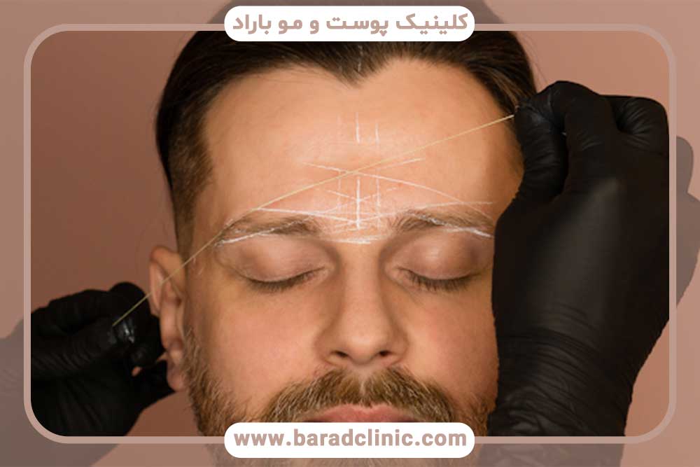 قیمت کاشت ابرو مردانه تهران