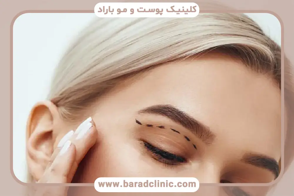 بلفاروپلاستی بدون جراحی تهران چیست؟