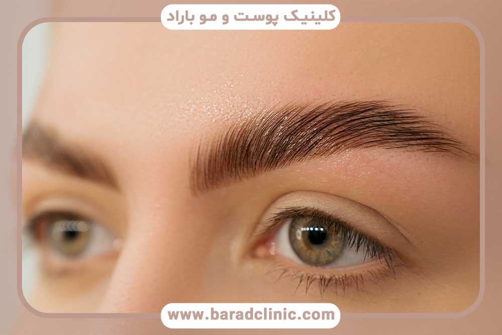 کاشت ابرو پهن با موی بلند