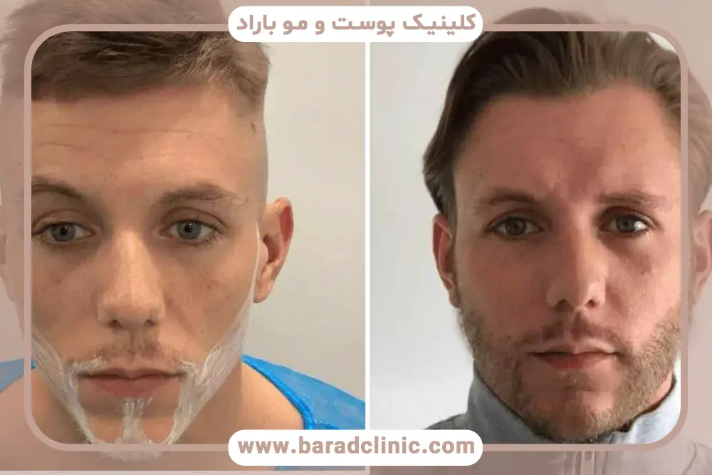 انواع بانک مو مناسب برای کاشت ریش 