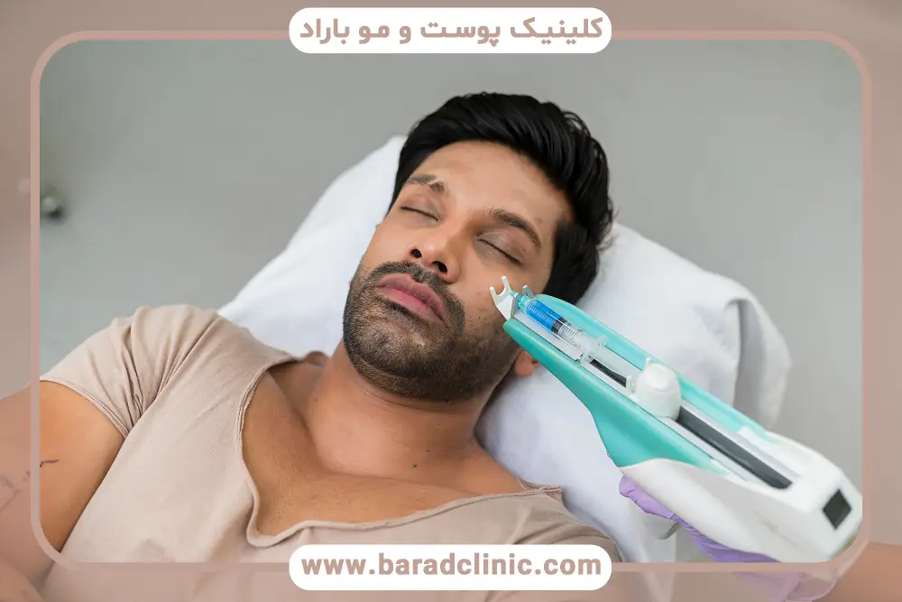 مزوتراپی ریش بعد از کاشت ریش چیست؟ 