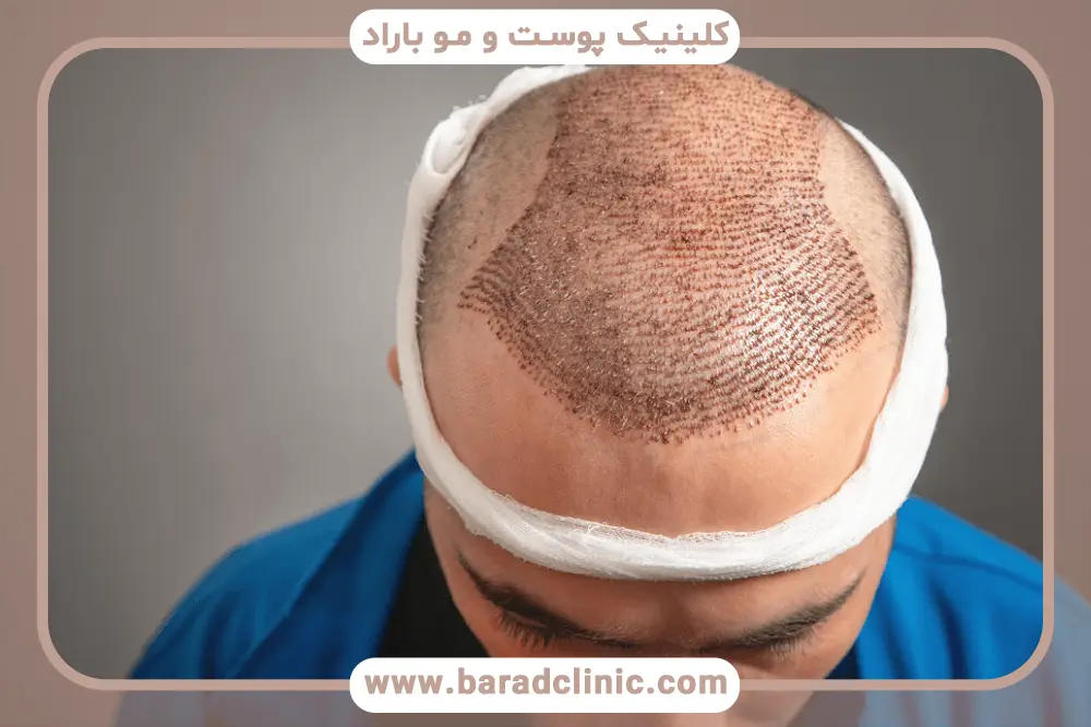 دلایل ریزش مو بعد از کاشت مو