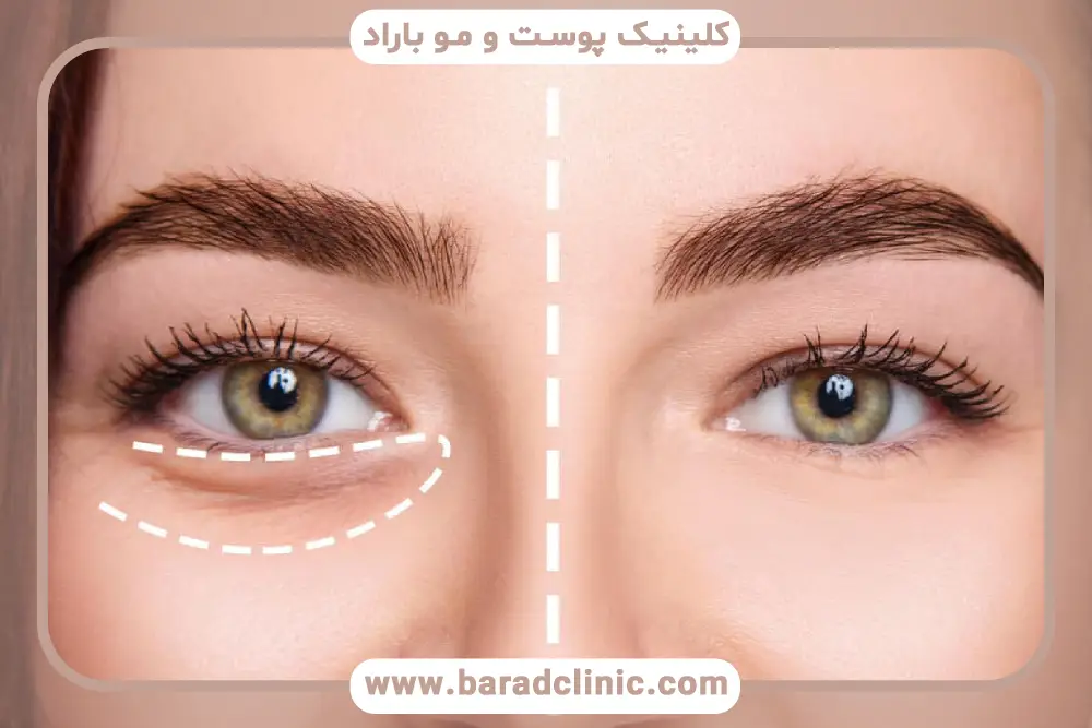 بررسی هزینه انواع روش بلفاروپلاستی تهران