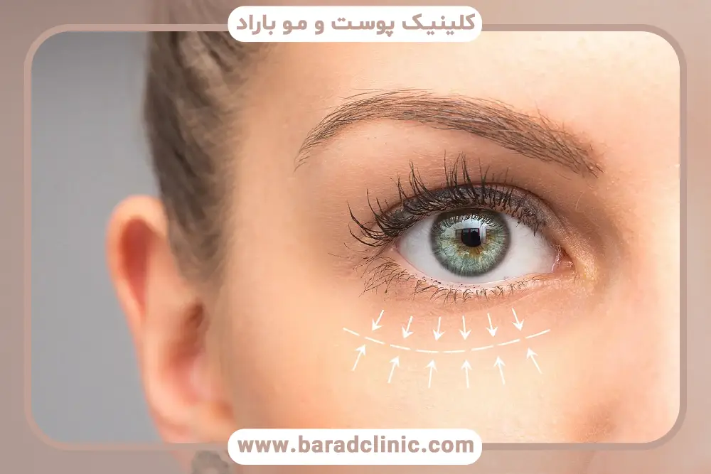 عوامل موثر بر هزینه جراحی بلفاروپلاستی فوقانی